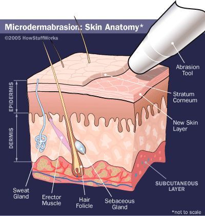 microdermabrasion_how_it_works