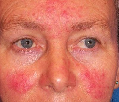 Acne Rosacea on face 