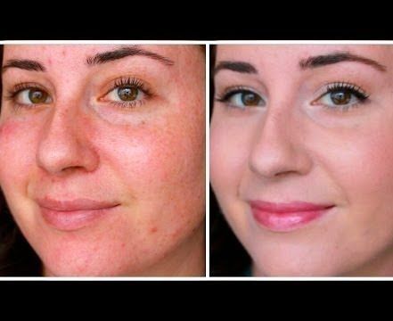 Acne Rosacea on face 1 