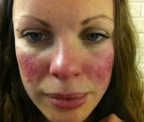 Acne Rosacea