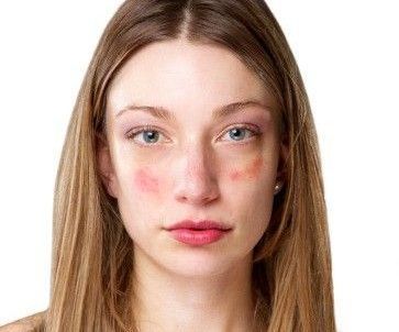 Acne Rosacea on face