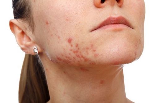 Acne Vulgaris