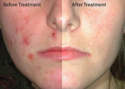 acne vulgaris treatment
