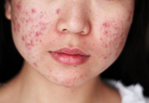 Acne Vulgaris 2