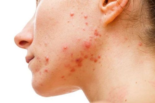 Acne Vulgaris 3