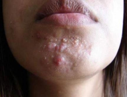 Cystic Acne