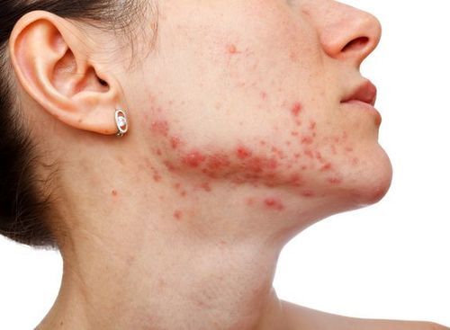 Cystic Acne-