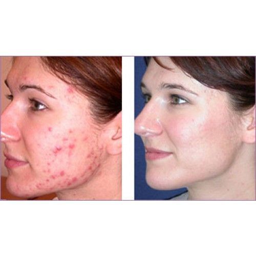 Cystic-Acne-before -and-after