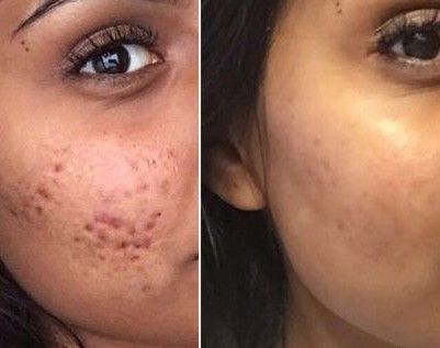 Cystic Acne before and after