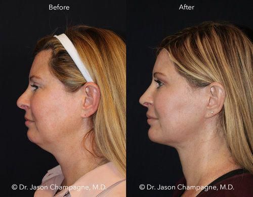 laser-skin-tightening-before-and-after