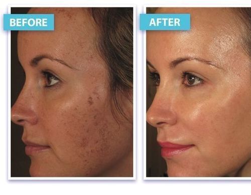 laser-skin-tightening-before-and-after-results