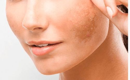 Hyperpigmentation-guide-types-causes-and-treatments
