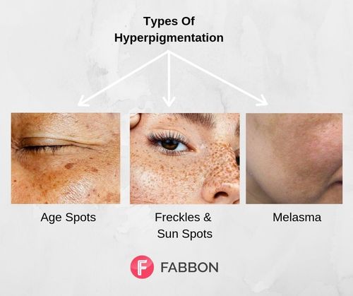 Hyperpigmentation-types
