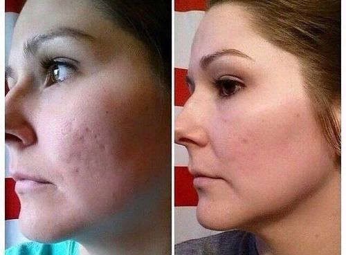 Microdermabrasion-facial-before-and-after