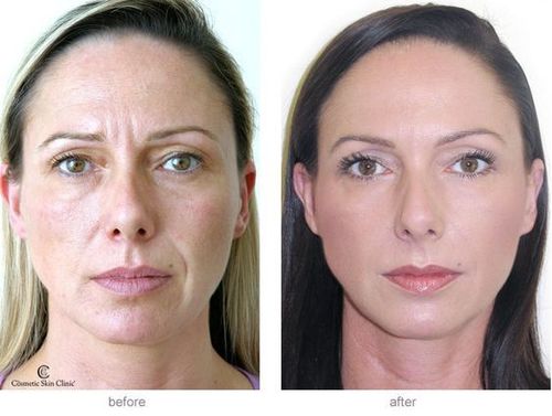 Dermal-fillers-before-and-after-2