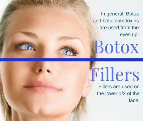 Dermal-fillers-vs-botox