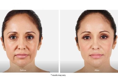 Dermal-fillers-before-and-after-
