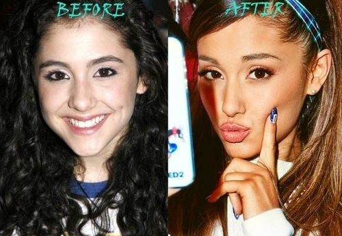 Ariana-Grande-Plastic-Surgery-Nose-Job