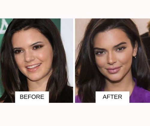 kendall jenner lip job