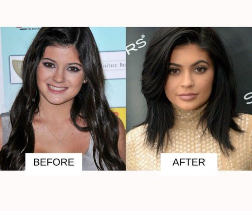 Kylie jenner lip job