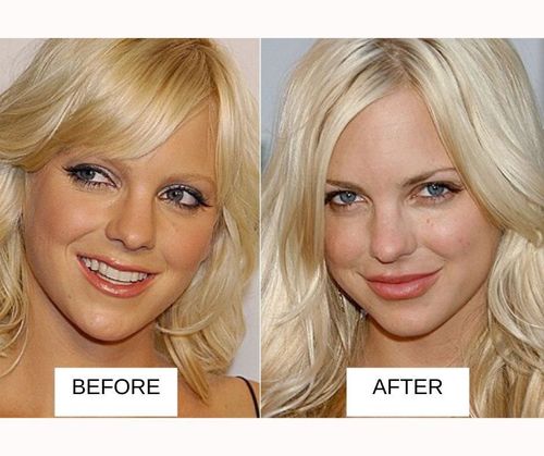 Anna Faris lip job