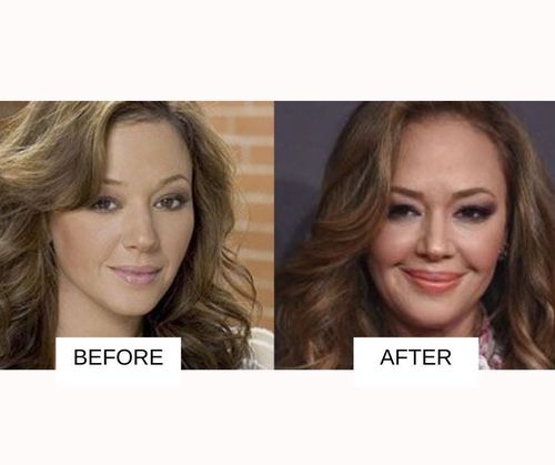 Leah Remini lip job