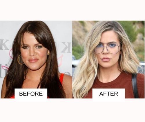 Khloe Krdashian lip job