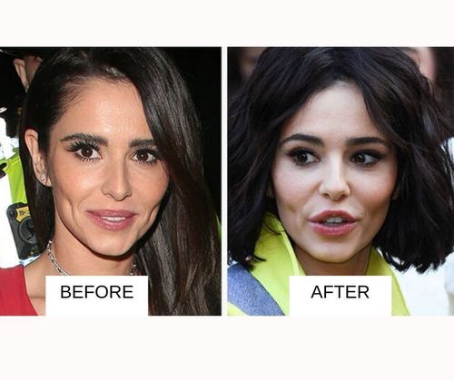 cheryl cole lip job