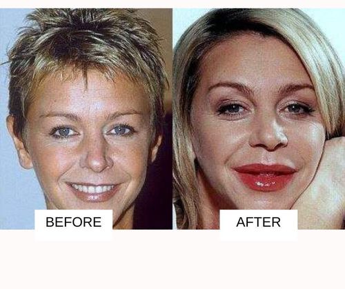 Leslie Ash lip job