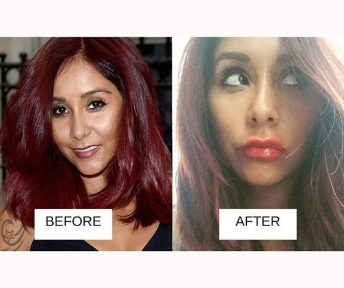 Snooki lip job