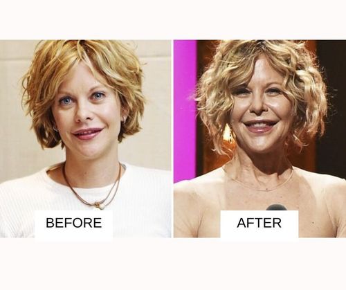 Meg Ryan lip job