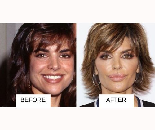 Lisa Rinna After Lip Surgery