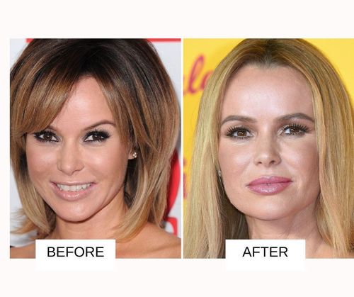 Amanda Holden lip job