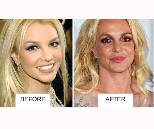 britney spears lip job