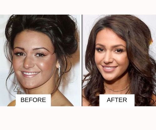 Michelle Keegan lip job