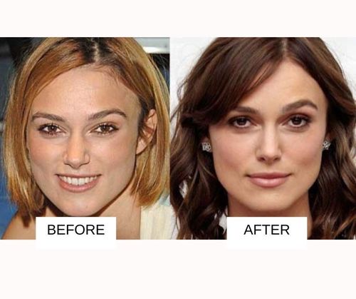 Keira Knightley lip job