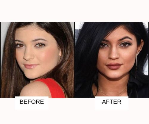 Kylie jenner brow lift