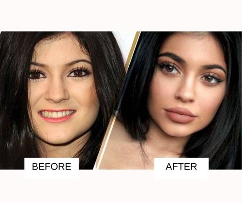 Kylie jenner lip fillers