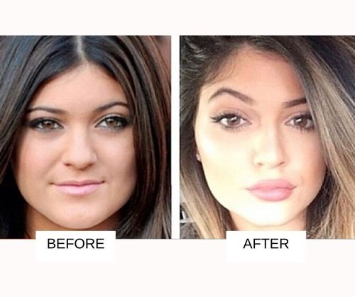 Kylie jenner Nasolabial Fillers