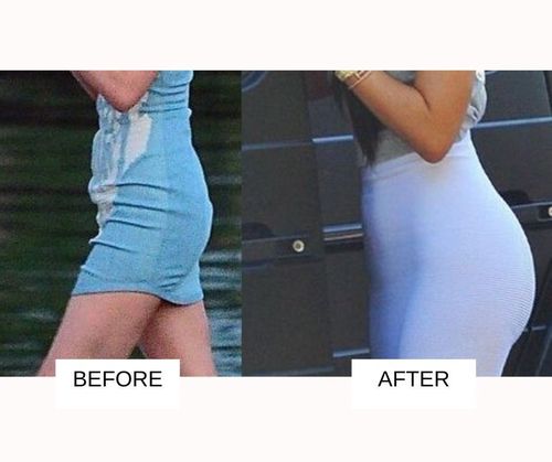 Kylie jenner Butt Lift