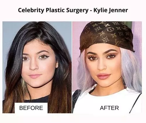 Kylie jenner plastic surgery