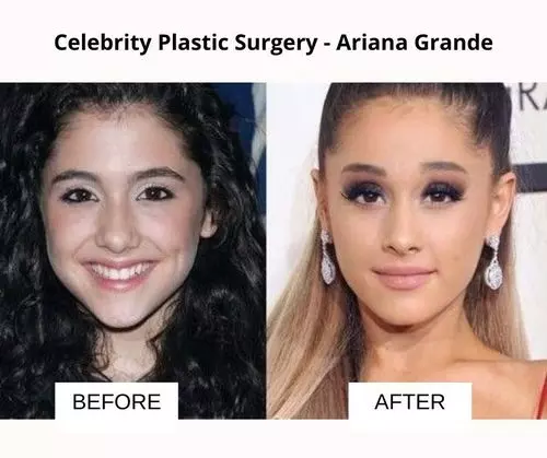 Ariana Grande plastic surgery