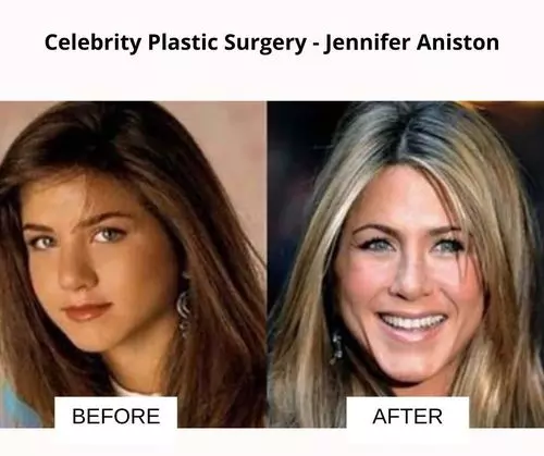 Jennifer Aniston plastic surgery