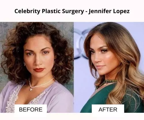 Jennifer Lopez plastic surgery