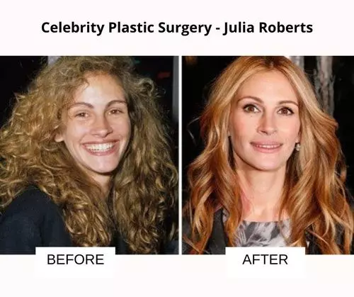Julia Roberts plastic surgery