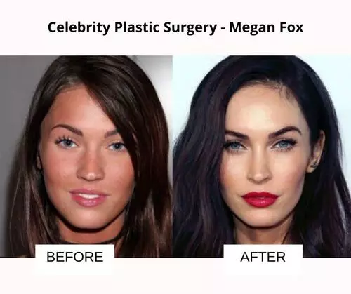 Megan Fox plastic surgery