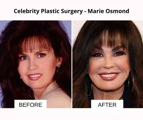 Marie Osmond plastic surgery