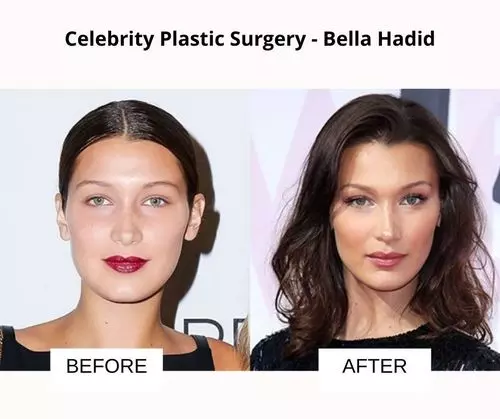 celebrities before and after plastic surgery