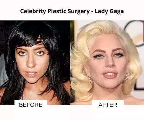 Lady Gaga plastic surgery