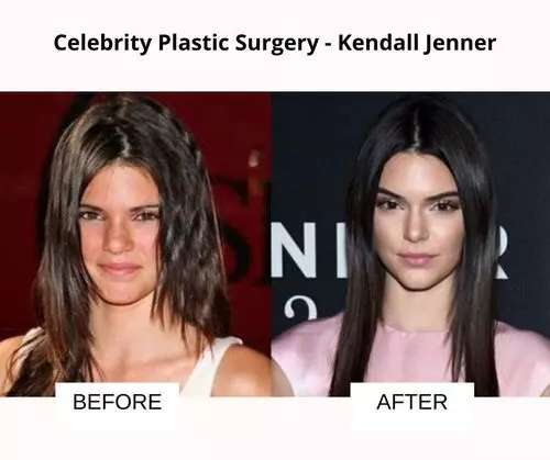 Kendall Jenner plastic surgery